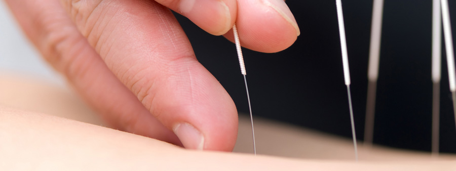 Akupunktur