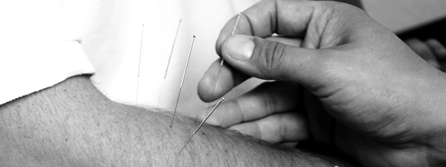 Akupunktur
