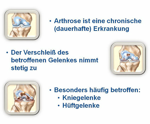 Arthrosetherapie